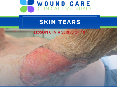 Wound Care Clinical Essentials:  Skin Tears