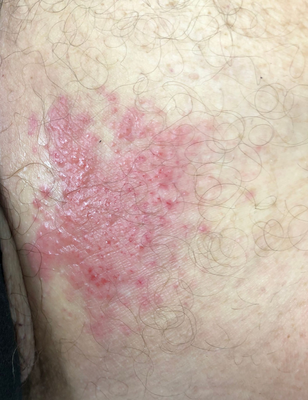 Candida Albicans Skin Rash Pictures