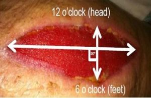 wound measuring
